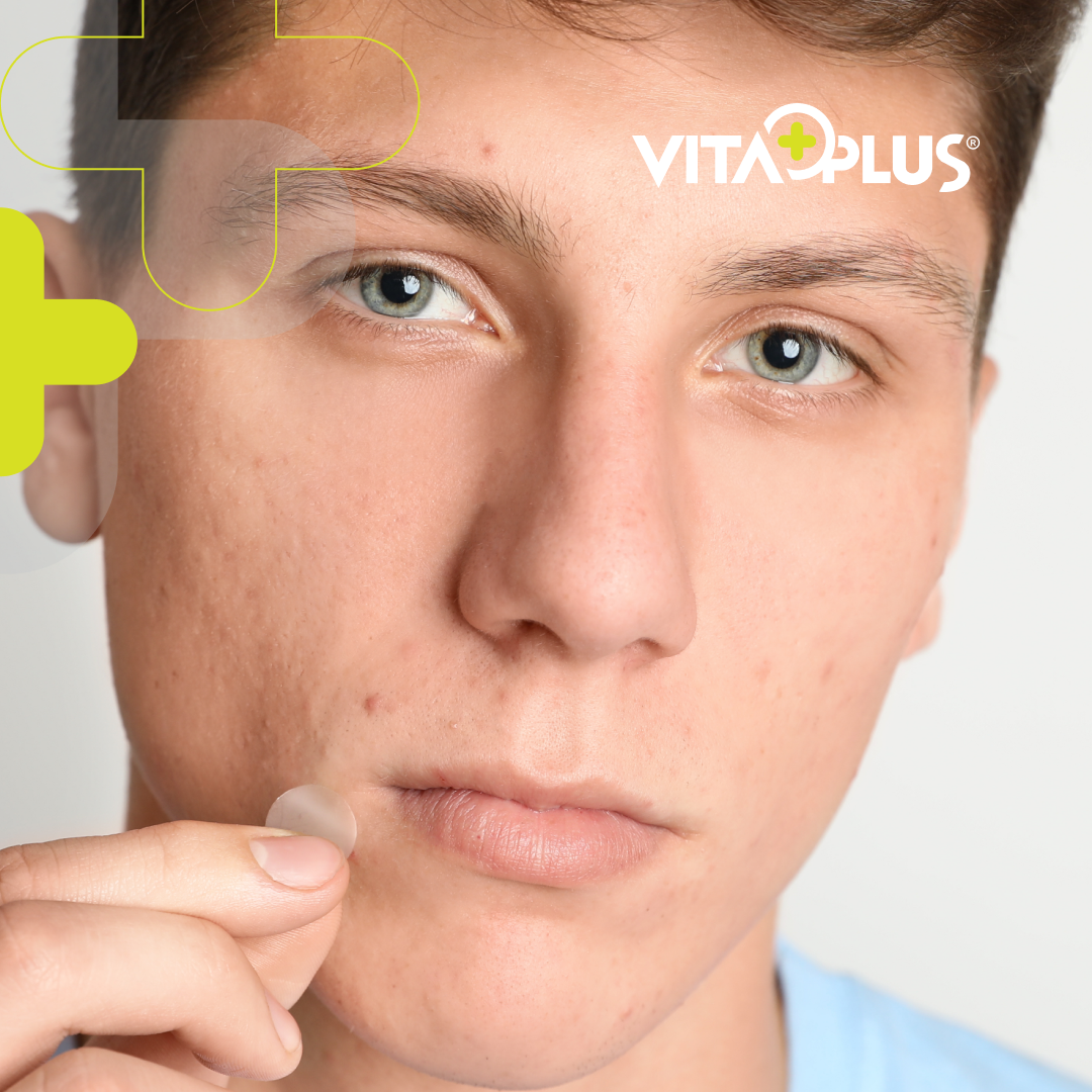 VitaPlus Acne Patches (24PCS)